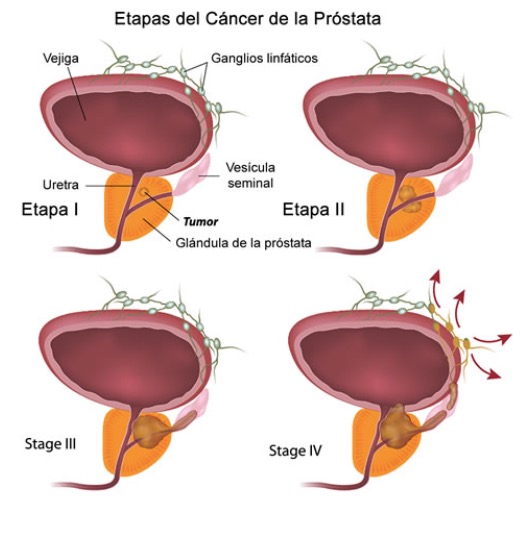 cancerdeprostata