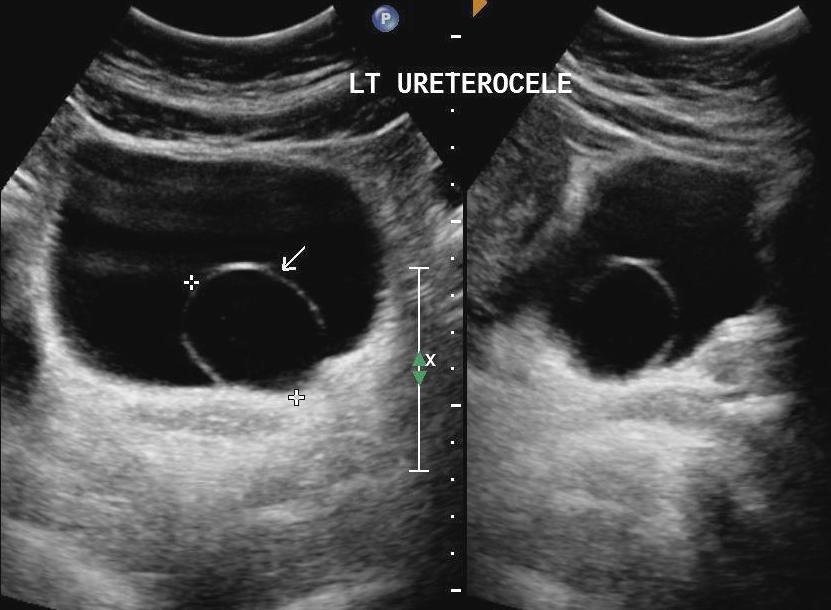 Ureterocele