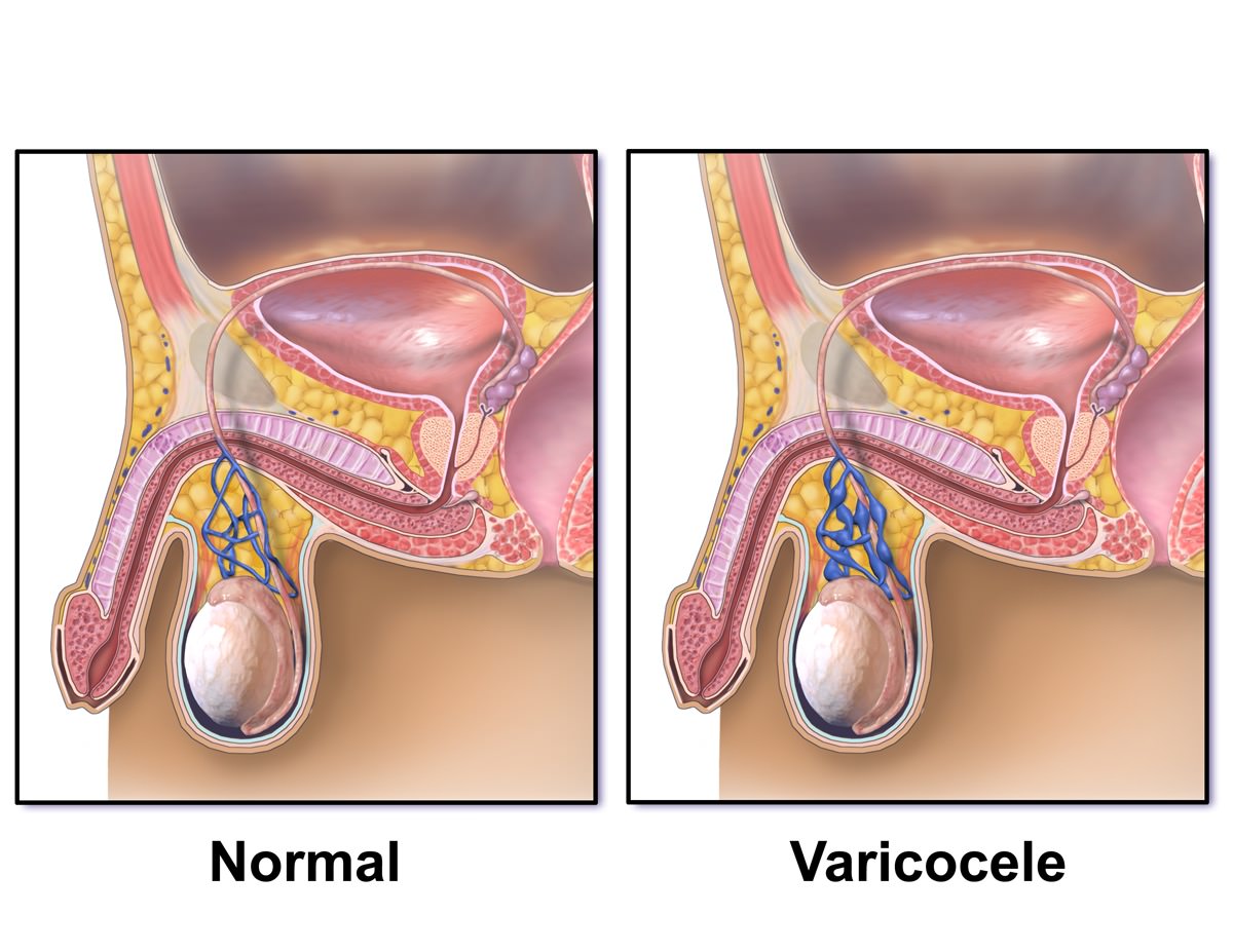 Varicocele