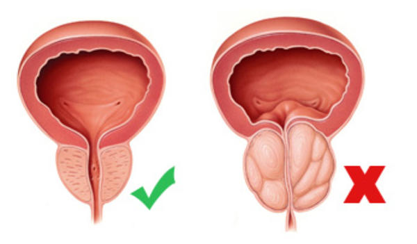 prostatabenigna02