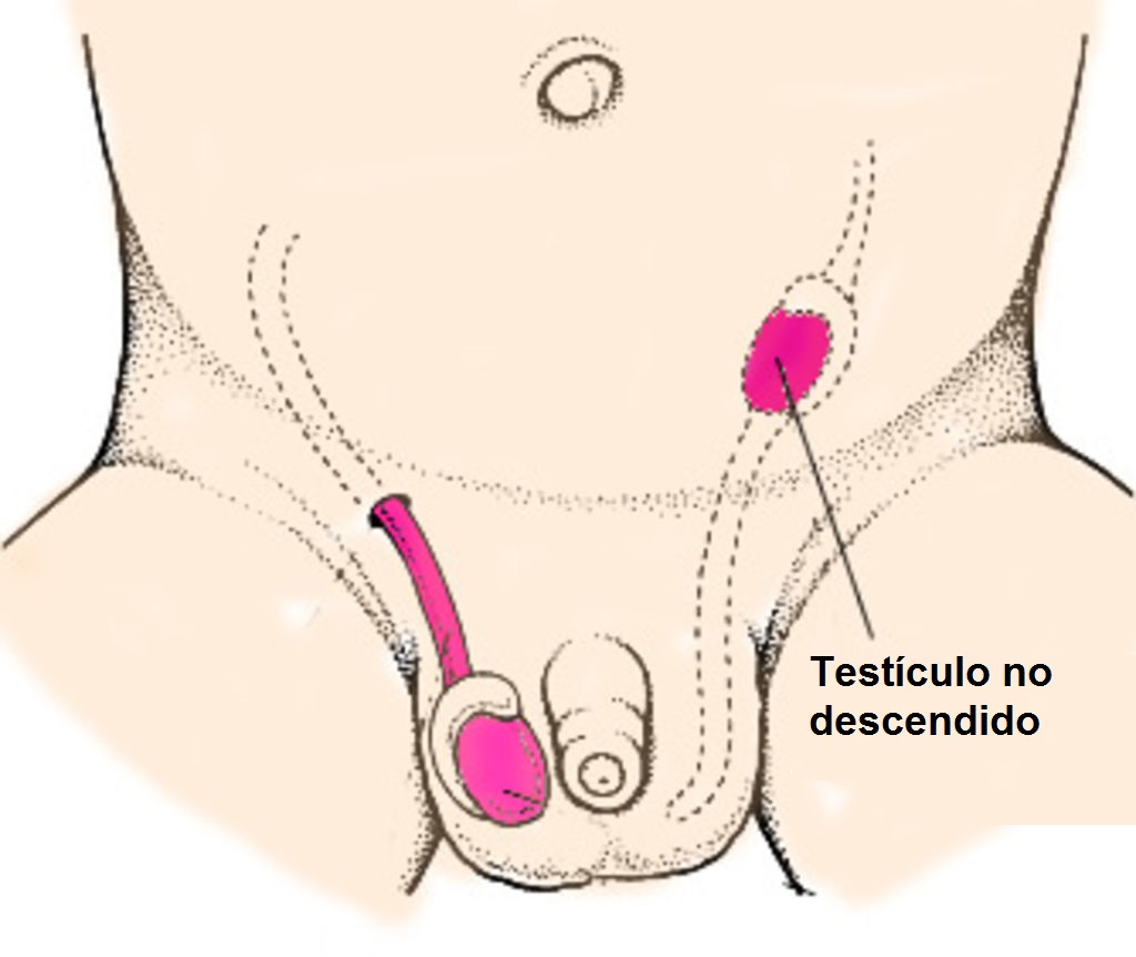 Testículo no descendido criptorquidia